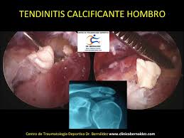 Tendinitis Calcificante-SPORTME