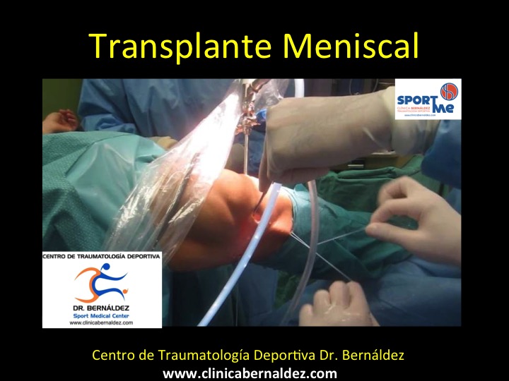 En este momento estás viendo Transplante Meniscal Rodilla.