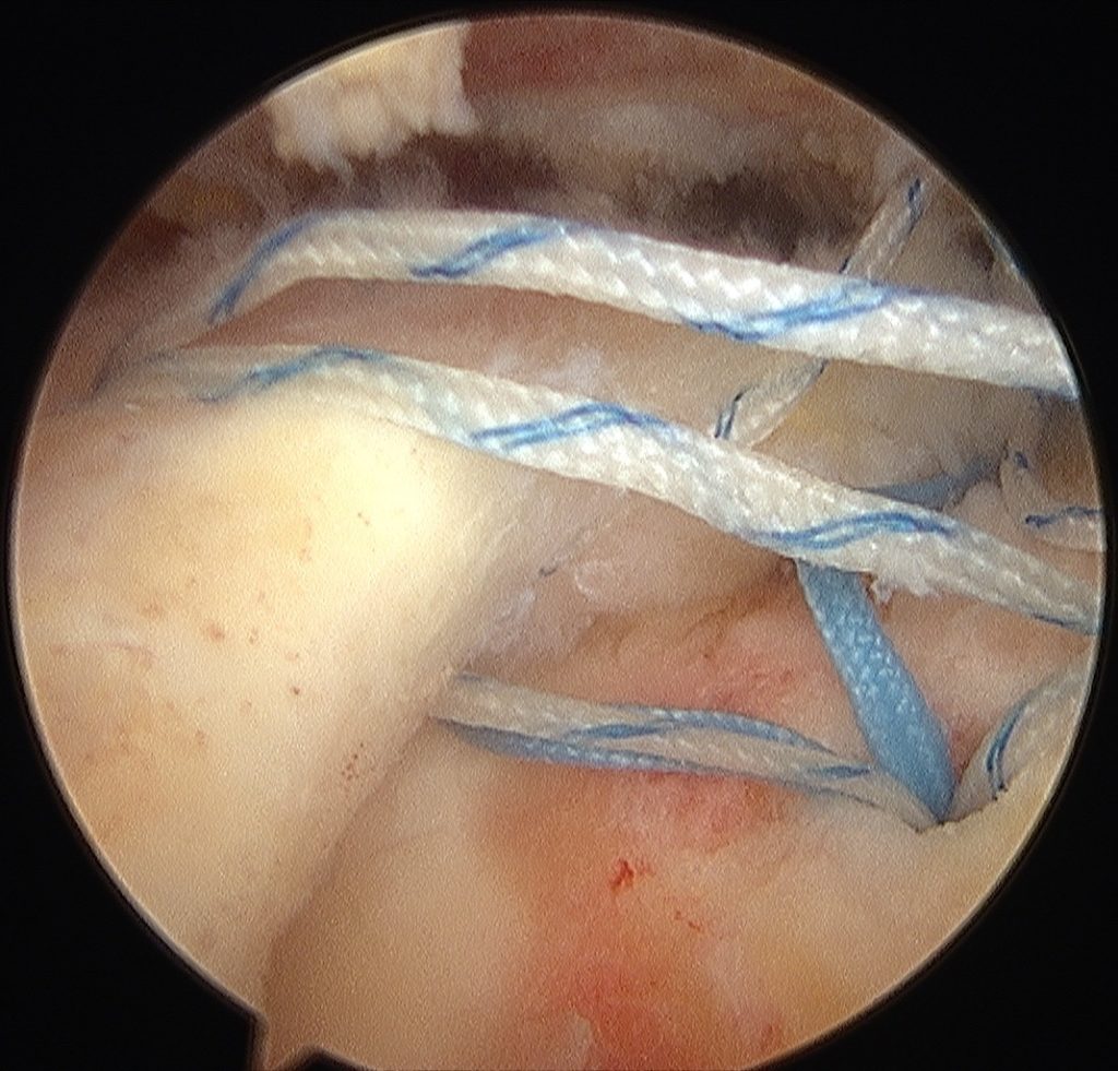 sistematica sutura artroscopica subescapular, supraespinoso e infraespinoso, experto en hombro, cirujano de hombro, cirujano de hombro sevilla