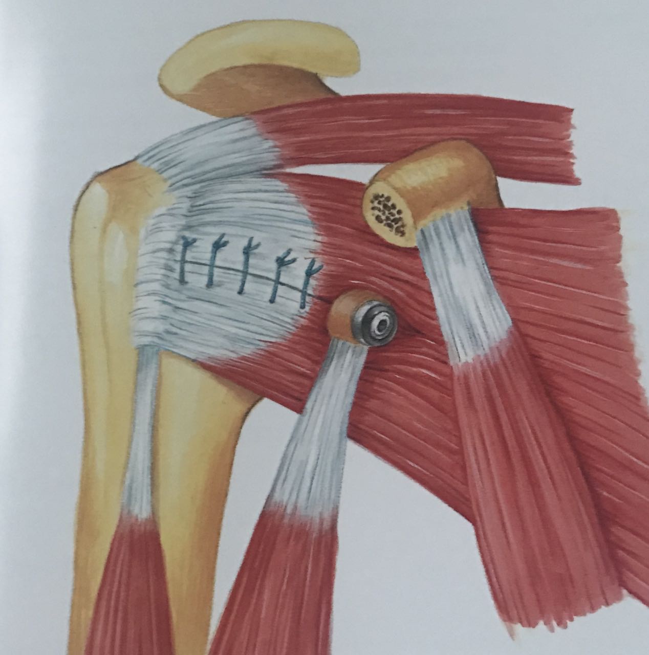 En este momento estás viendo Tecnica de Latarjet para las inestabilidades de hombro tras fracaso del bankart artroscopico