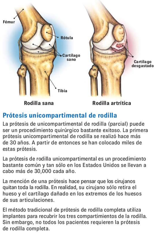 Protesis unicompartimental de rodilla SportMe.