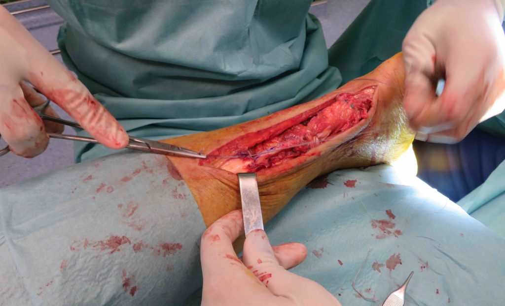 sutura tendon aquiles