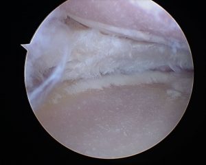 artrosis de rodilla con ausencia completa de cartilago