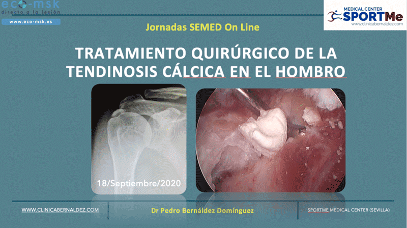 PONENCIA DR BERNALDEZ Seminario web ECO Tendinosis Calcica