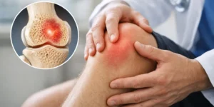 ¿Cuánto tarda en curar edema óseo?
