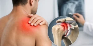 Guía de lesión del labrum de hombro